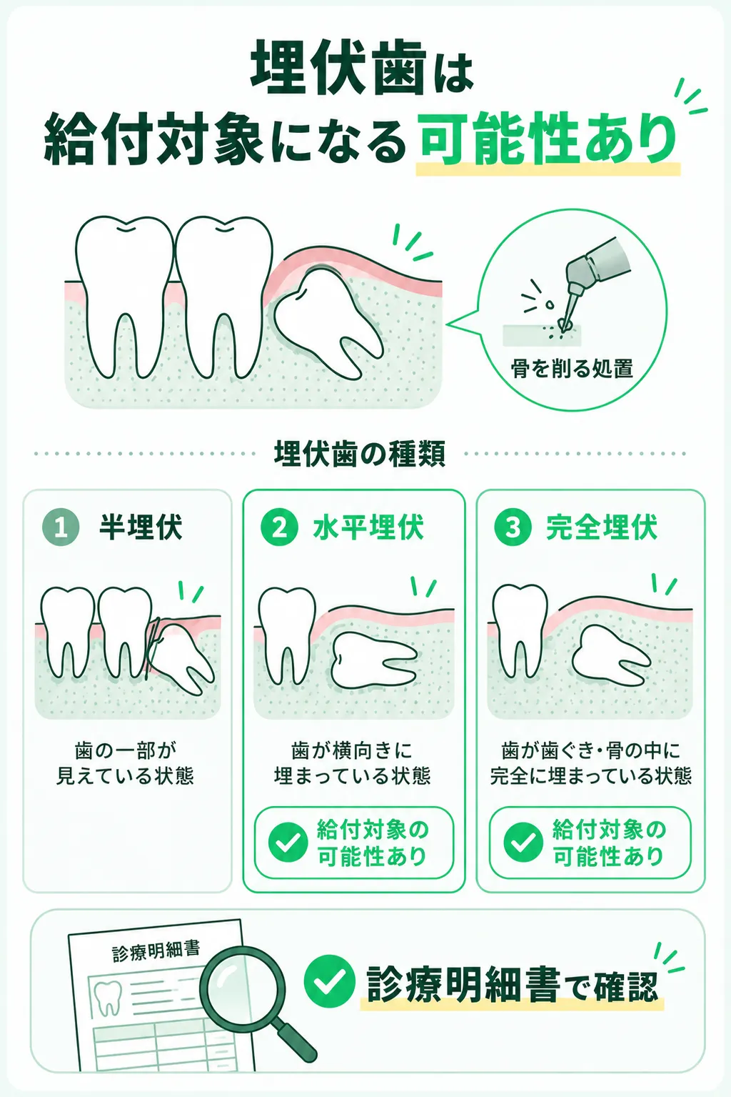 埋伏歯（骨削り含む）での給付