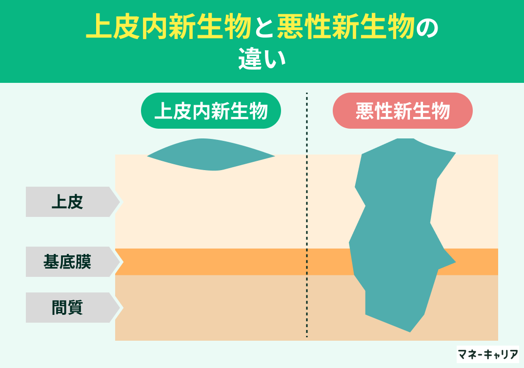 上皮内新生物と悪性新生物の違い